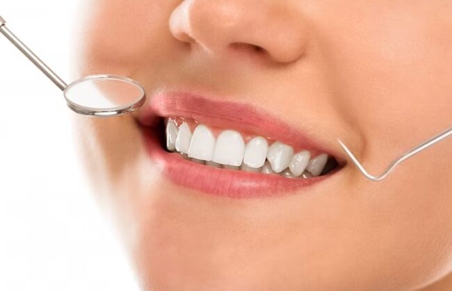 teeth whitening in Galveston