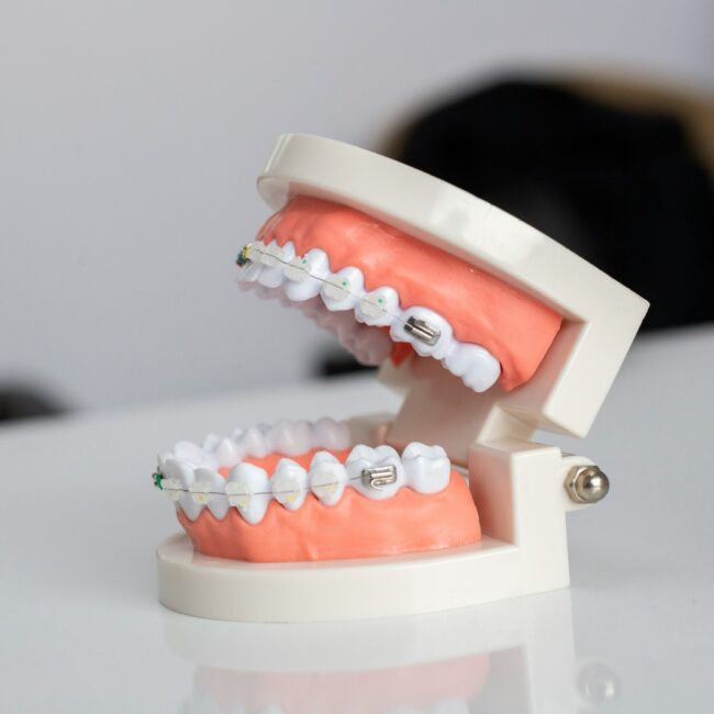 wisdom teeth extraction in Galveston